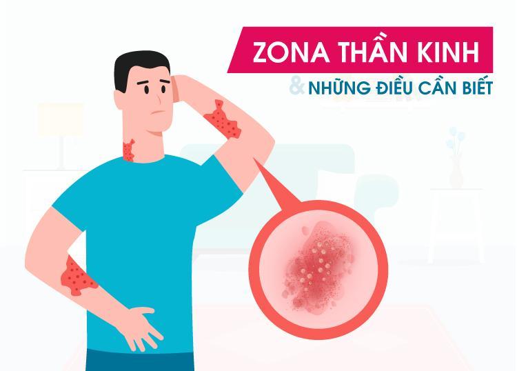 BỆNH ZONA THẦN KINH